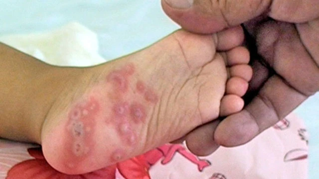 Biểu hiện nốt phỏng ở lòng bàn chân trong bệnh tay chân miệng. (Ảnh: suckhoedoisong.vn).
