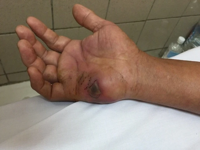 Hình ảnh nốt rắn hổ mang chúa cắn trên tay bệnh nhân.