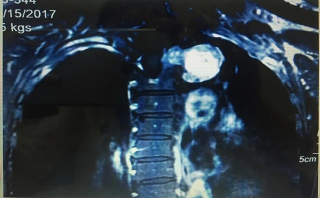 Phim chụp vị trí của khối u trong tủy sống và lồng ngực của bệnh nhân Y (Ảnh: Bệnh viện cung cấp).