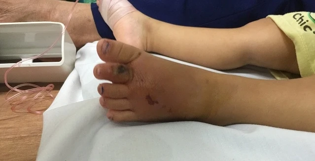 Vết hoại tử trên chân của bệnh nhi Nguyễn Duy Kh. đang hồi phục tốt.