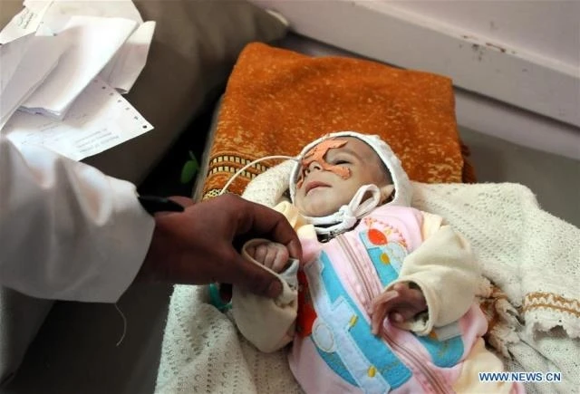 Em bé bị suy dinh dưỡng được điều trị tại bệnh viện ở Sanaa, Yemen, ngày 15-1. (Ảnh: Tân Hoa xã)
