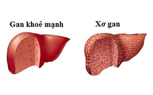 Phần lớn người mắc bệnh gan ở Việt Nam được phát hiện muộn