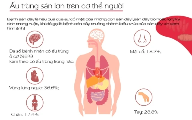[Infographic] Nhận diện về bệnh sán dây, ấu trùng sán lợn