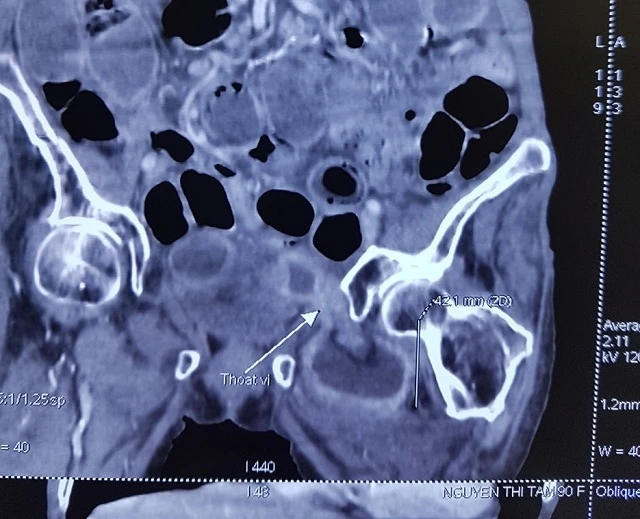 Hình ảnh chụp CT của bệnh nhân. 