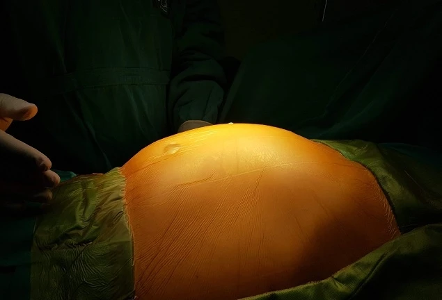 Phẫu thuật thành công khối u mạc treo khổng lồ