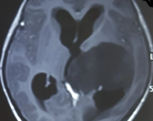 Hình ảnh phim chụp u tế bào thần kinh đệm của bệnh nhân. (Ảnh:BSCC)