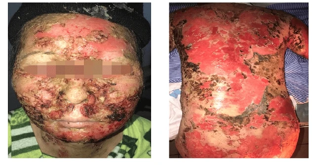 Hình ảnh tổn thương của bệnh nhân khi vào viện ngày 8-4. (Ảnh: BVCC)