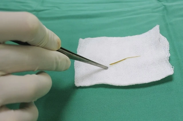 Mảnh xương cá dài 4 cm đâm thủng ruột non bệnh nhân. 
