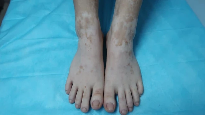 Hình ảnh tổn thương da chân của nữ bệnh nhân sử dụng lá trầu không ngâm chân. (Ảnh: Bác sĩ cung cấp)