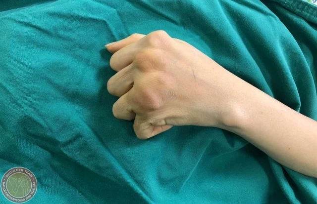Bàn tay bị biến dạng của bệnh nhân. 
