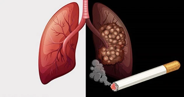 90% bệnh nhân ung thư phổi do hút thuốc lá