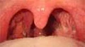 Viêm họng do liên cầu khuẩn ở trẻ em